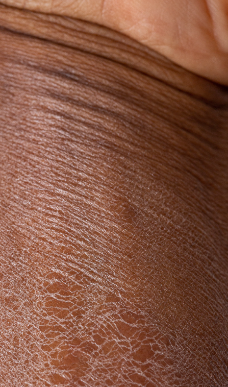 Close up of Dry Skin Before Ointment